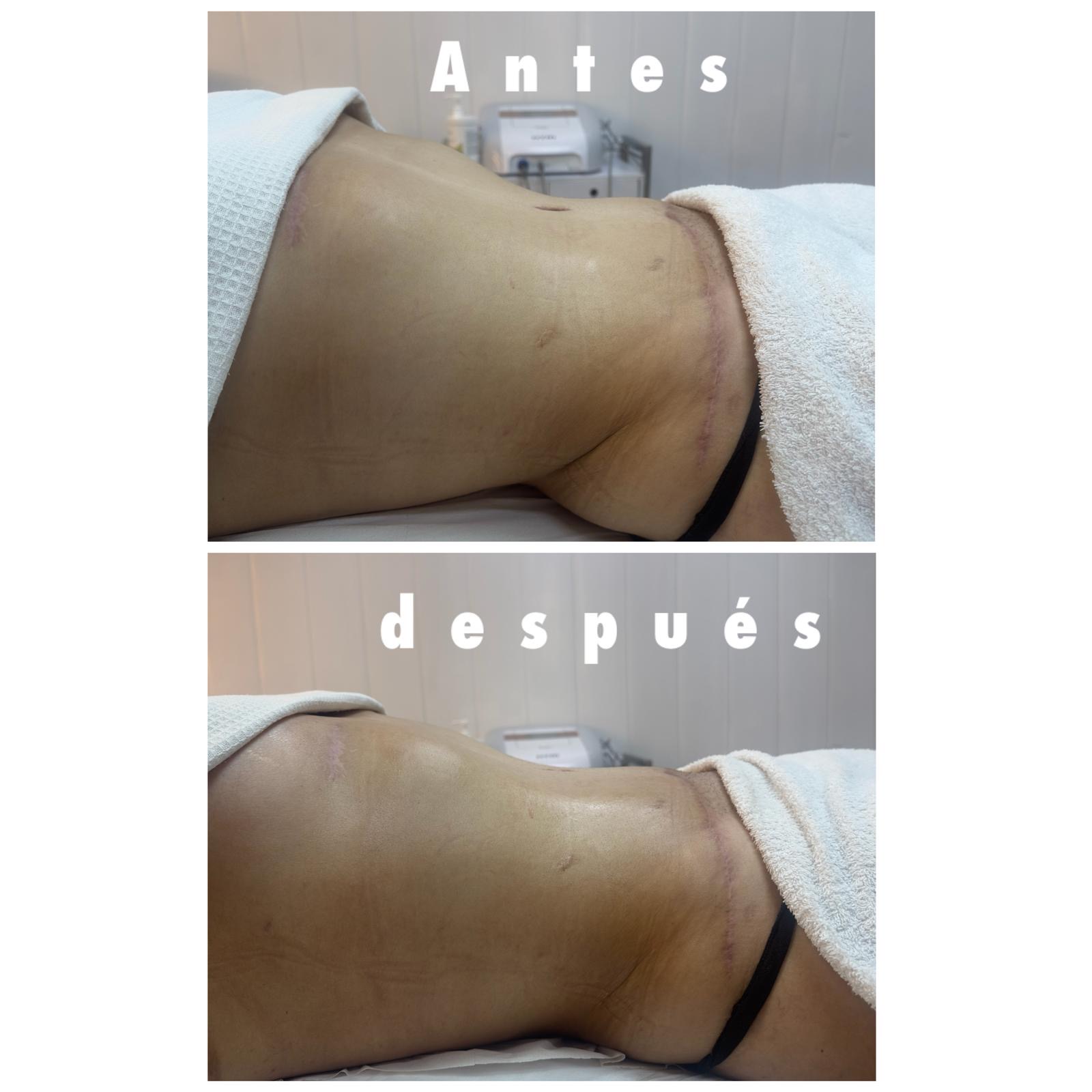 Resultado antes y después de drenaje linfático en Barcelona
