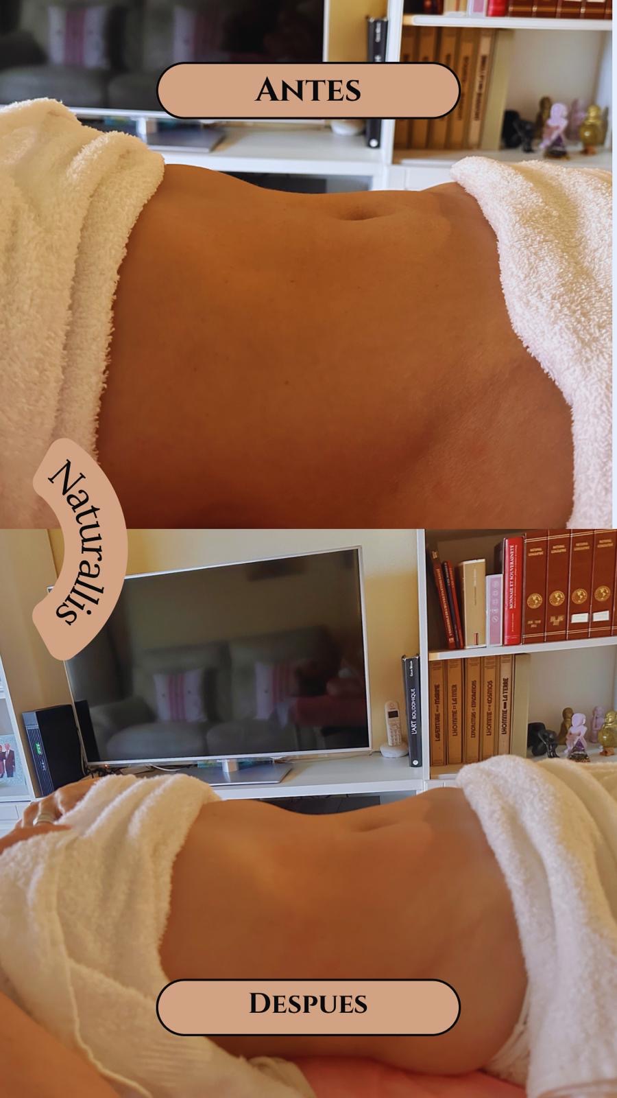 Resultado antes y después de tratamiento post-operatorio Barcelona